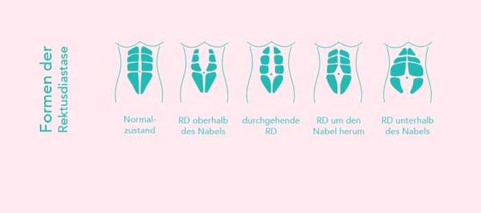 Rectusdiastase